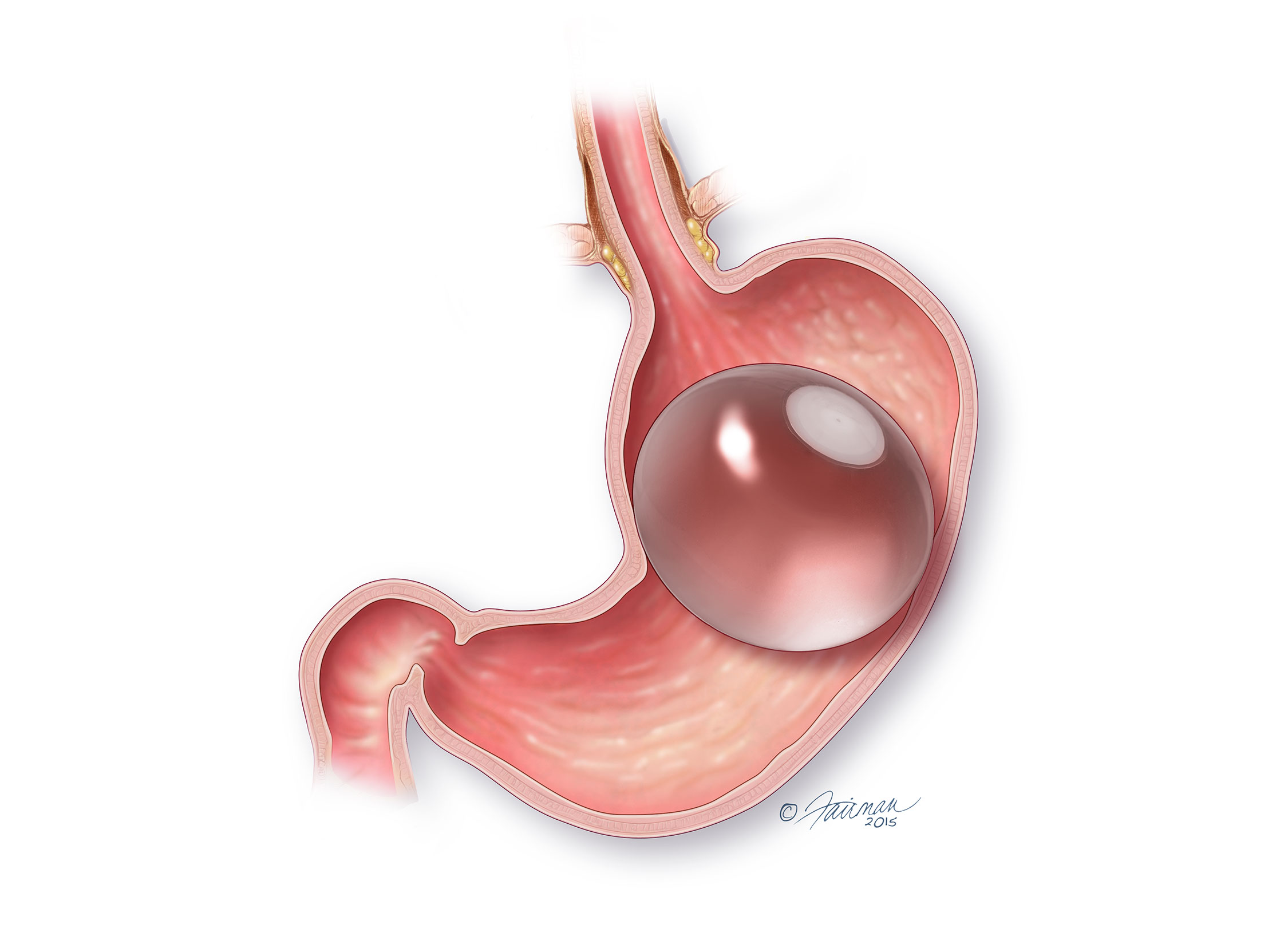 ORBERA® Gastric Balloon