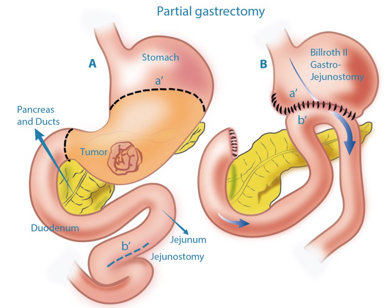 Partial Gastrectomy